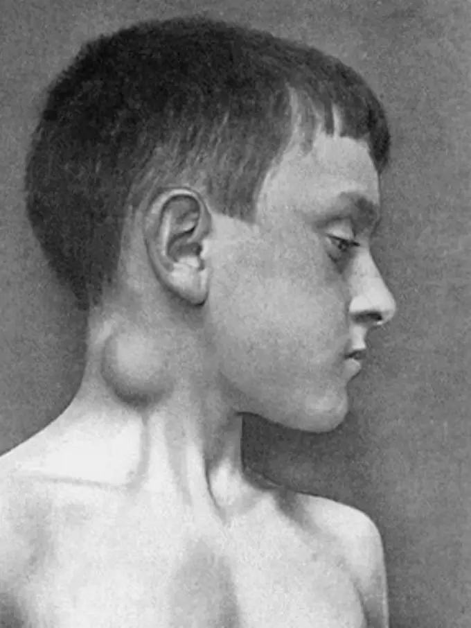 Kenali Ciri-ciri Penyakit TBC Kelenjar yang Dialami Misye Arsita