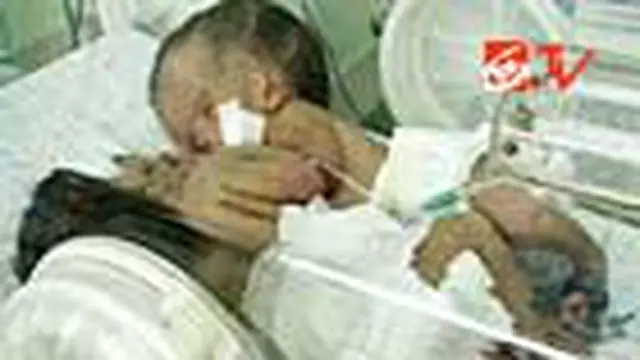 Bayi Kembar Siam Buleleng Masih Dirawat Intensif