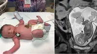 Ajaib, Bayi Ini Lahir ke Dunia Sebanyak Dua Kali