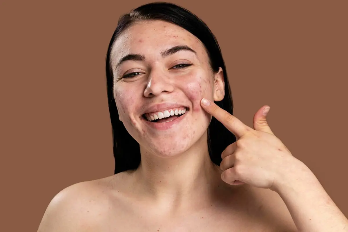 Tidak Perlu Takut Breakout, Begini Cara Aman Memilih dan Menggunakan Serum Untuk Pemula - 1
