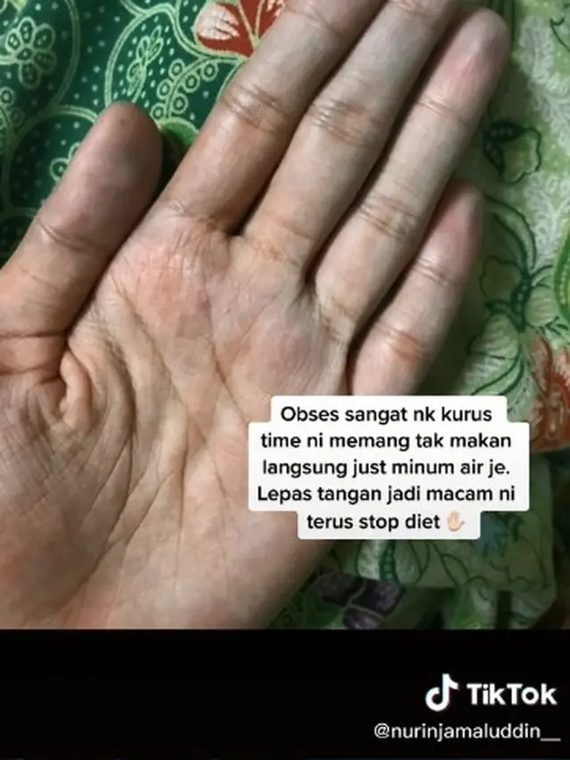 Perempuan Berhenti Diet Air Putih Usai Jari-Jari Tangan Berubah Biru