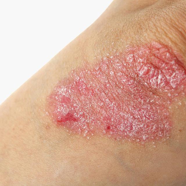 5 Cara Alami Untuk Kurangi Gatal Akibat Psoriasis Health