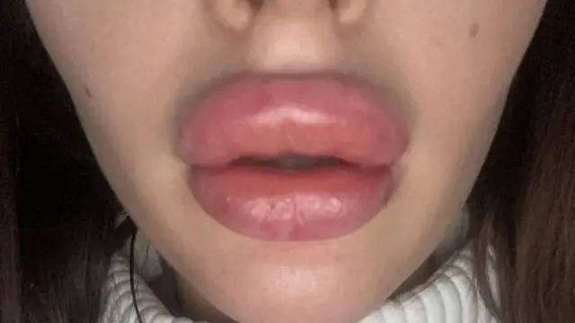 Lakukan Suntik Filler dengan Harga Murah, Bibir Wanita Ini Malah Bengkak Seperti Mau Meletus