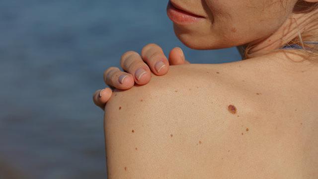 Ilustrasi Kutil atau Daging Tumbuh (sumber: unsplash)