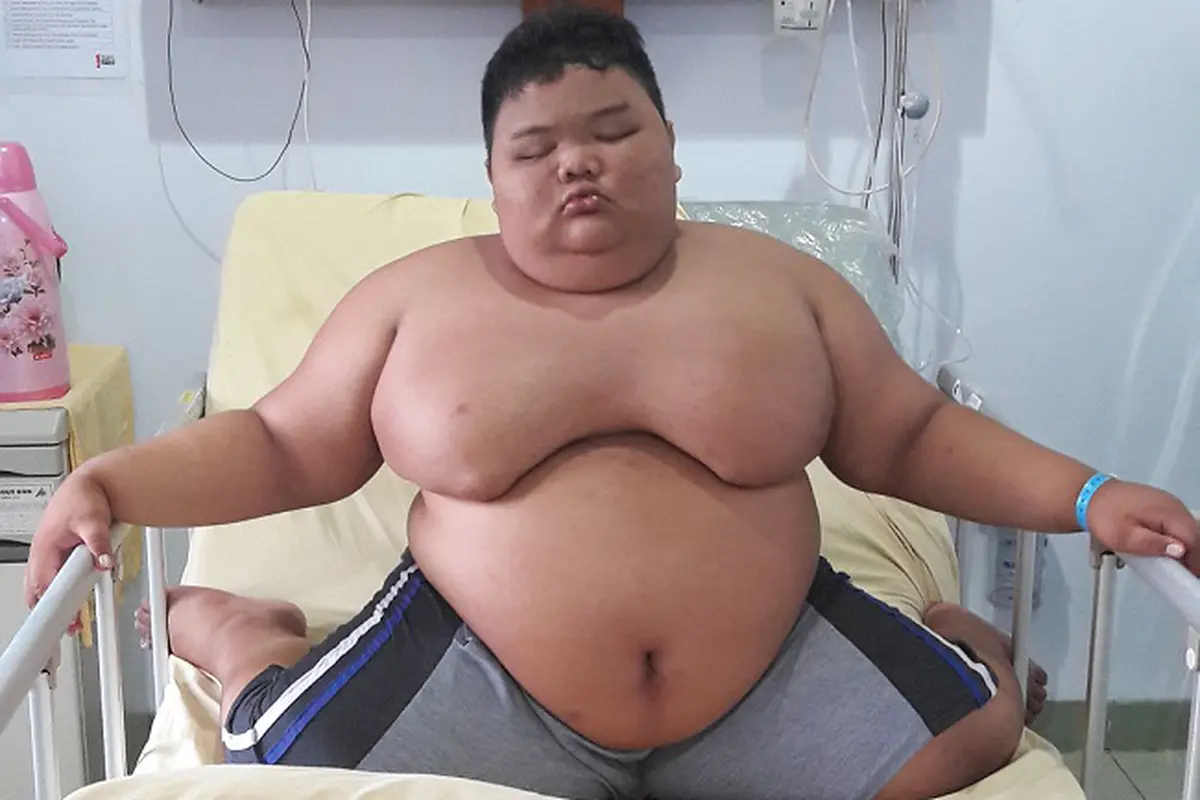 Ibu Rizki Bocah Obesitas Palembang: Anak Saya Koma