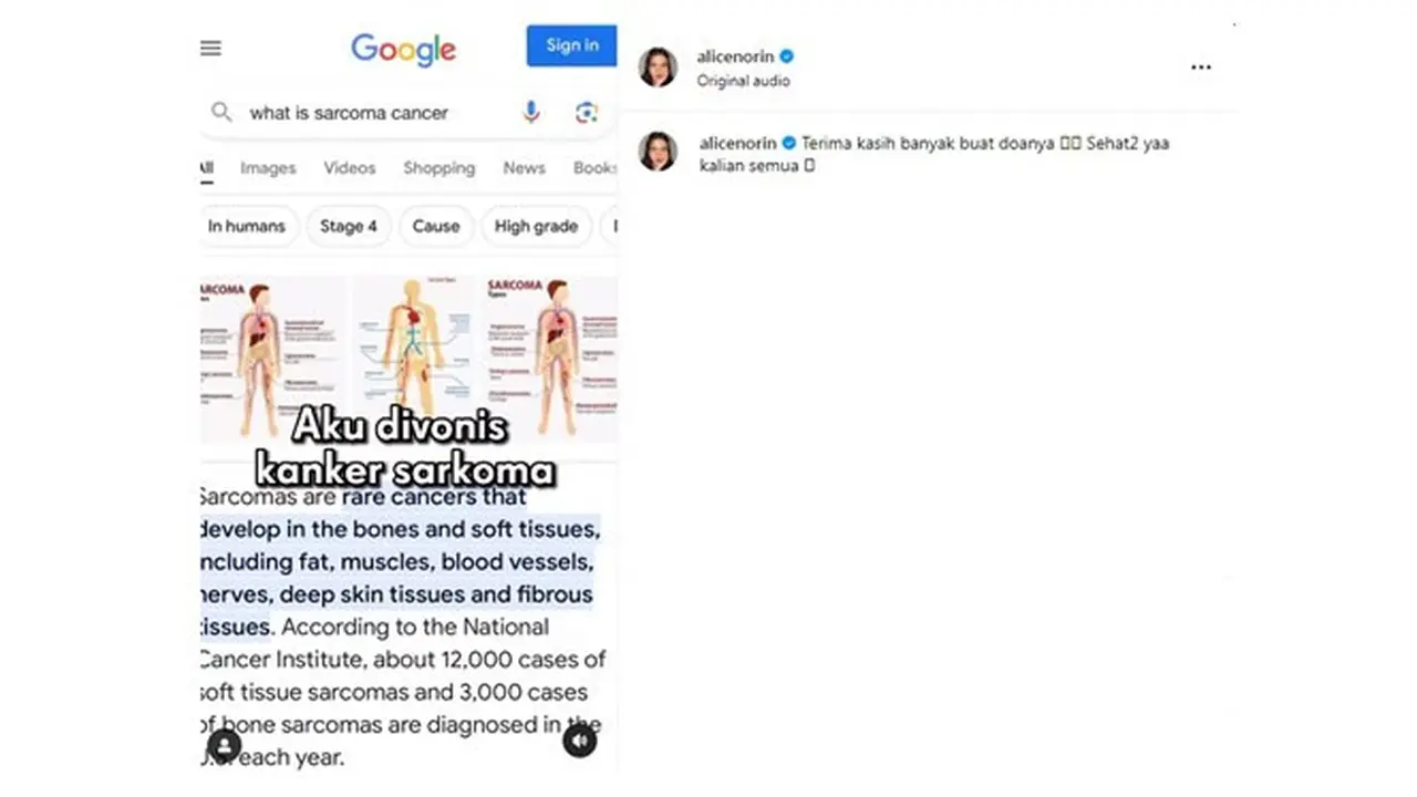 12 Potret Kondisi Alice Norin Usai Divonis Kanker Sarkoma, Terpaksa Menopause Dini