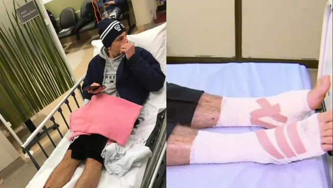 Apa Itu Kutu Laut yang Gerogoti Kaki Remaja Australia?