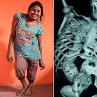 Meskipun berisiko kematian, perempuan India penderita skoliosis ini berani menerima tawaran operasi tulang belakang. 