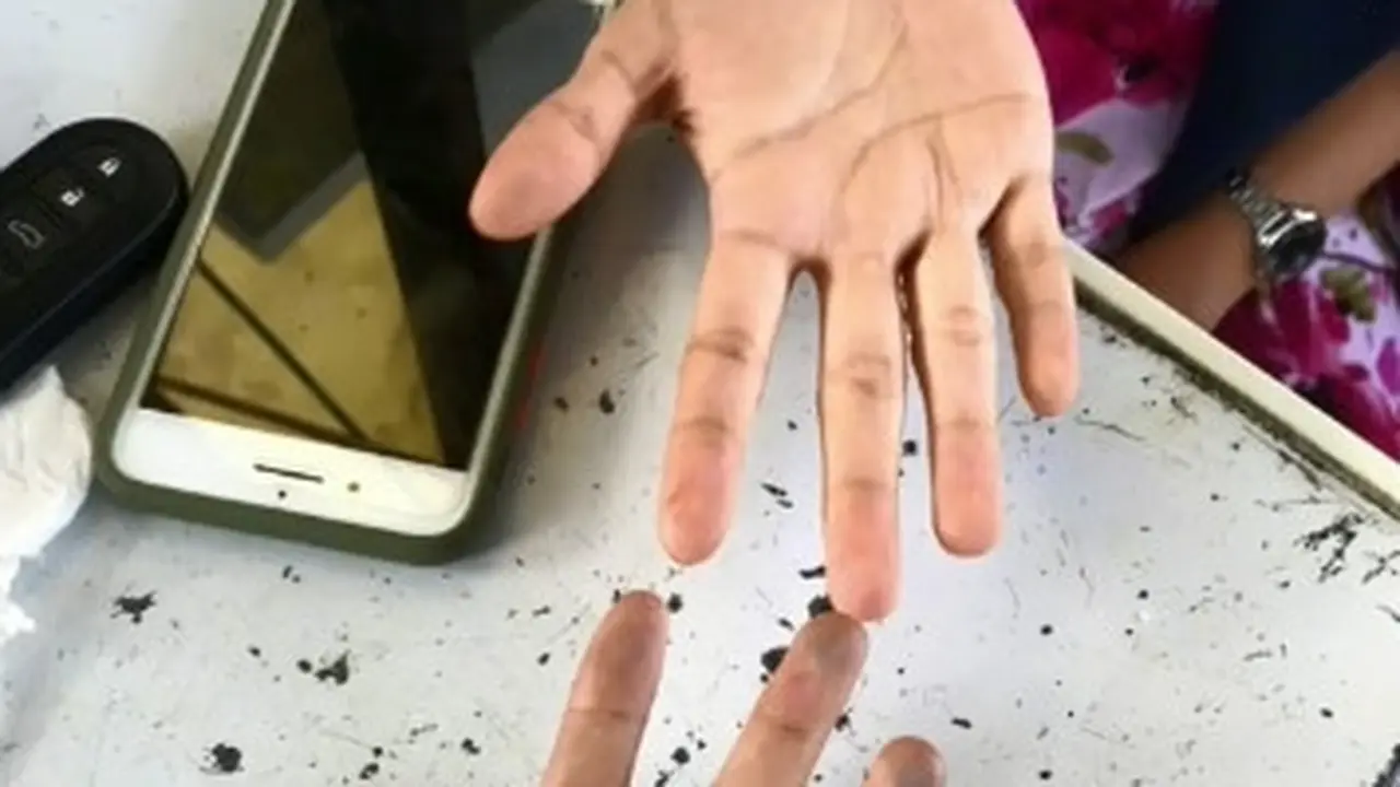 Sianosis Adalah Perubahan Kulit Tubuh Menjadi Kebiruan, Kenali Gejala dan Penyebabnya