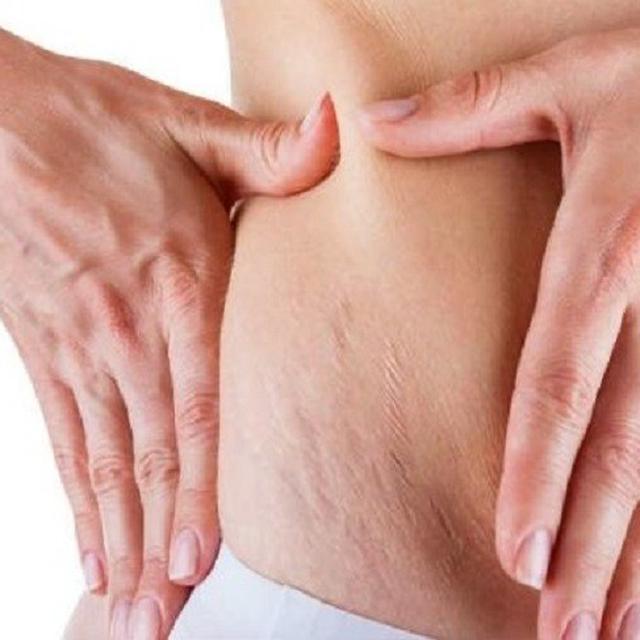Patut Dicoba 7 Bahan Alami Ini Ampuh Samarkan Stretch Mark Citizen6 Liputan6 Com