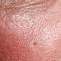 Ilustrasi pori-pori yang besar. (via: dokter.id)