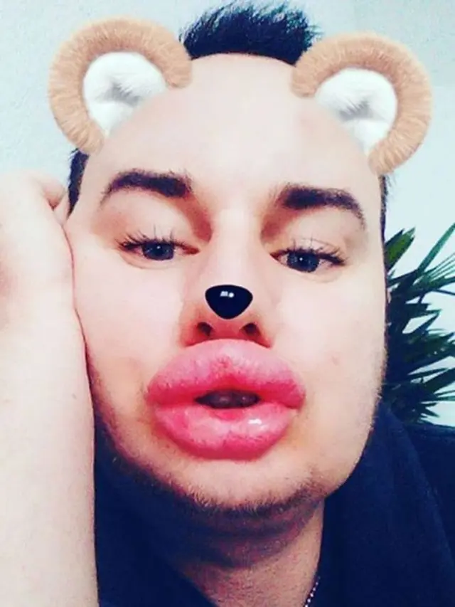 [Bintang] Sebelum Suntik Botox Cowok Ini Ganteng, tapi Sekarang Wajahnya...