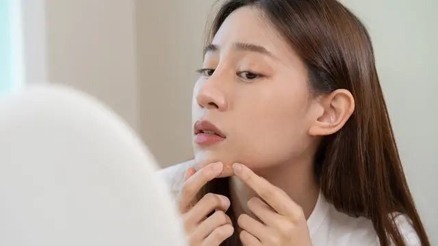 Kerap Bikin Remaja Minder, Begini Cara Mengatasi Jerawat yang Tepat