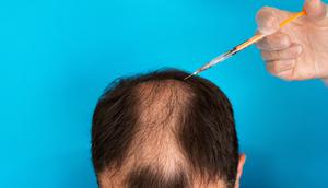 Ilustrasi seorang pria melakukan transplantasi rambut. (DepositPhotos.com/vfhnb12)