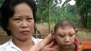 Citizen6, Kotabumi: Orang tua Keysha Febri Valentina, balita yang memiliki kelainan pada otaknya sehingga sisterm motoriknya menjadi lambat meskipun kelangsungan hidupnya besar. (Pengirim: Nurman Agung)