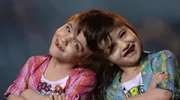 Tatiana dan Krista, Si Kembar dengan Satu Otak