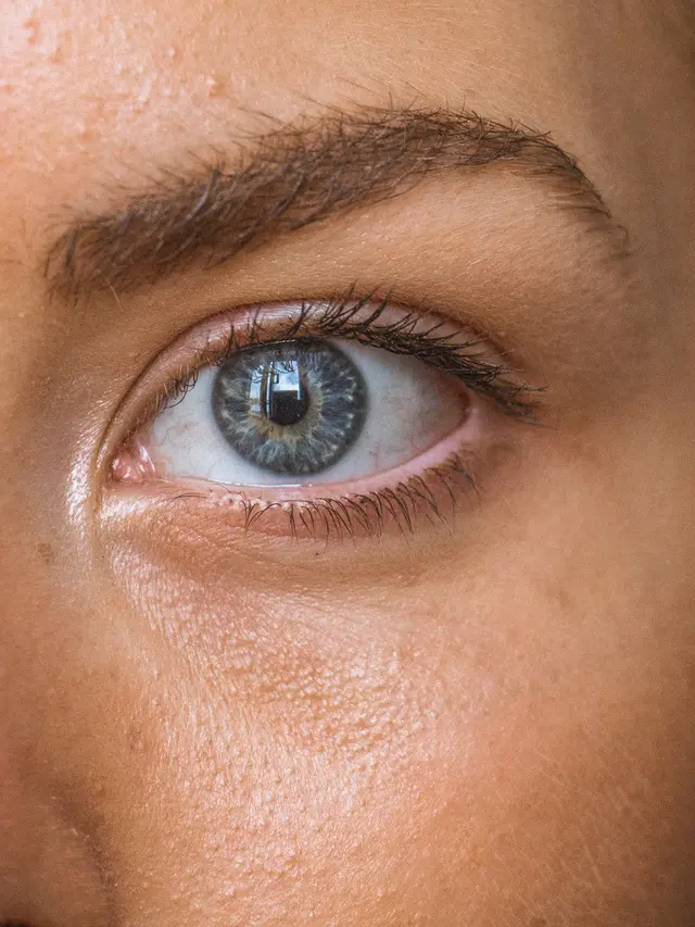 melasma