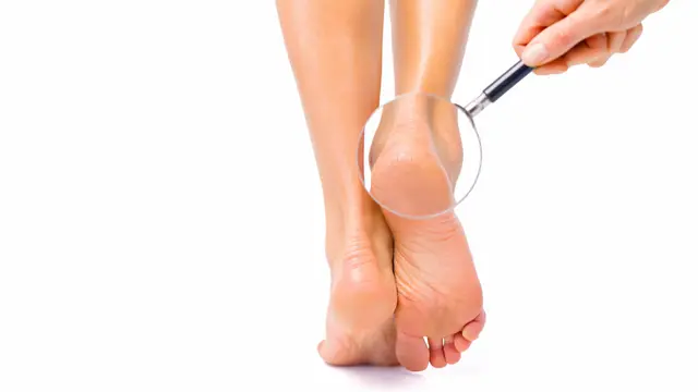 Trik Menghaluskan Tumit Kasar Biar Kondisinya Nggak Semakin Parah, Cek Perawatan Pentingnya!