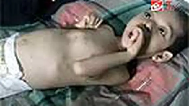 Seorang bocah sembilan tahun di Makassar terserang gizi buruk dan lumpuh layu. Penyakit ini juga menyerang tiga kakak beradik di Pulau Seram, Maluku.