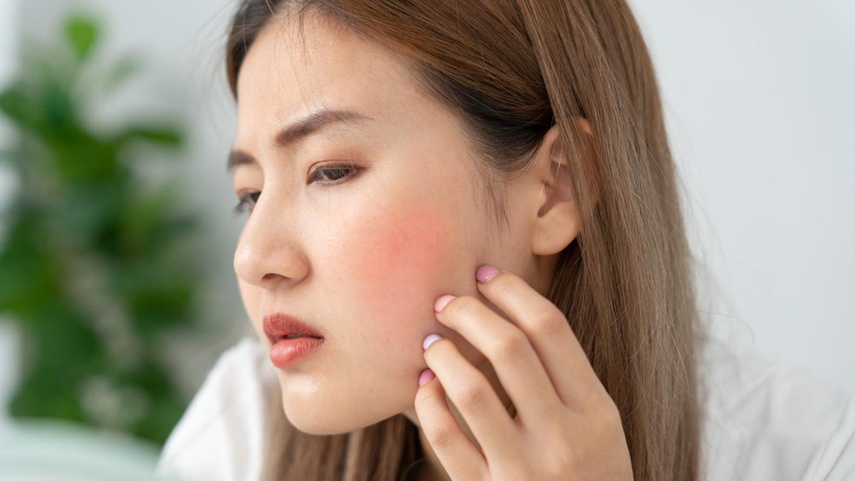 Glowing Tanpa Downtime, Laser VBeam Jadi Solusi Kurangi Gangguan Kemerahan dan Bekas Jerawat