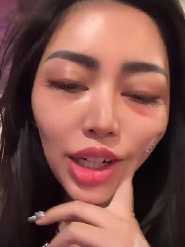 Artis Wajah Bengkak Pasca Oplas