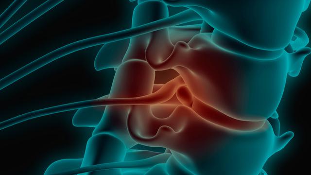 Bagian Tubuh yang Sering Alami Saraf Terjepit