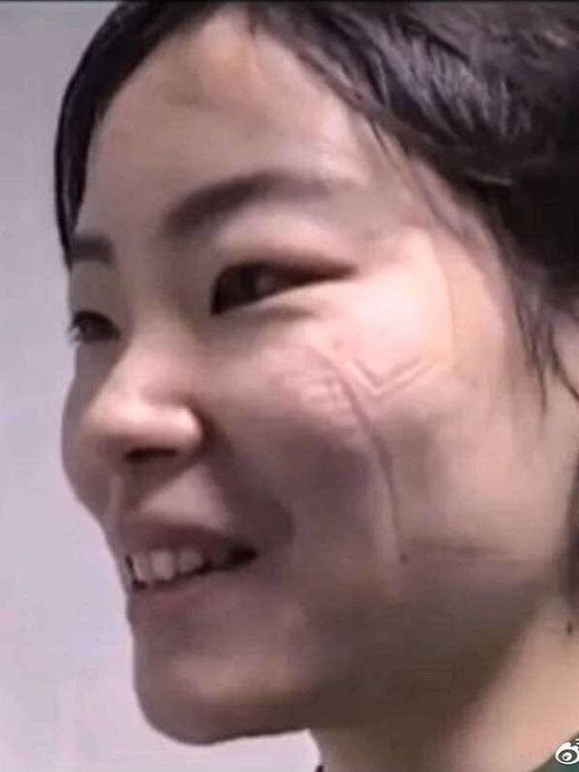 7 Potret Luka Lebam di Wajah Tim Medis Akibat Kacamata Pelindung Selama Perangi Virus Corona