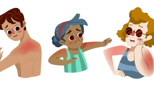 Ilustrasi sunburn, luka bakar akibat sinar matahari
