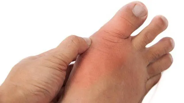 Jempol Kaki Anda Bengkak? Hati-Hati Gout