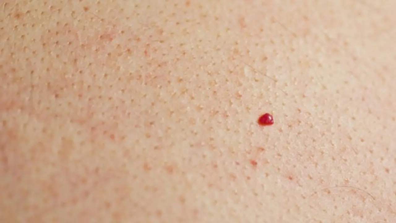 Bintik Merah Pertanda Tumor Muncul di Kulit, Haruskah Khawatir?