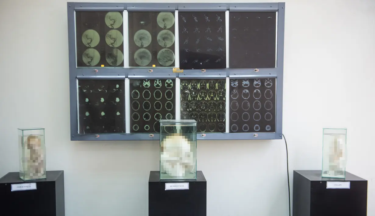 Sejumlah janin yang diawetkan di Museum Neuropatologi, di Rumah Sakit Santo Toribio de Mogrovejo, Lima, Peru (16/11). (AFP Photo/Ernesto Benavides)