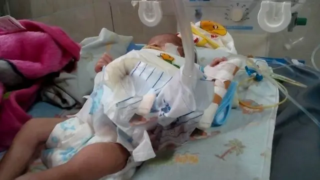 Bayi Arumi Adiba Nasha Razeta terlahir dengan kelainan dinding perut atau Gastrochisis. (Foto: Liputan6.com/Dok. Keluarga/Muhamad Ridlo)