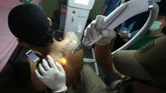 Petugas klinik menghapus tato di tubuh seorang pria bernama Taufiq Hidayat di Tangerang (9/8). Klinik tersebut menawarkan jasa hapus tato gratis dengan syarat pasien harus membaca dan belajar Alquran Surat Arrahman. (AP Photo/Achmad Ibrahim)