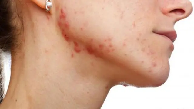 4 Cara Singkirkan Peradangan Jerawat