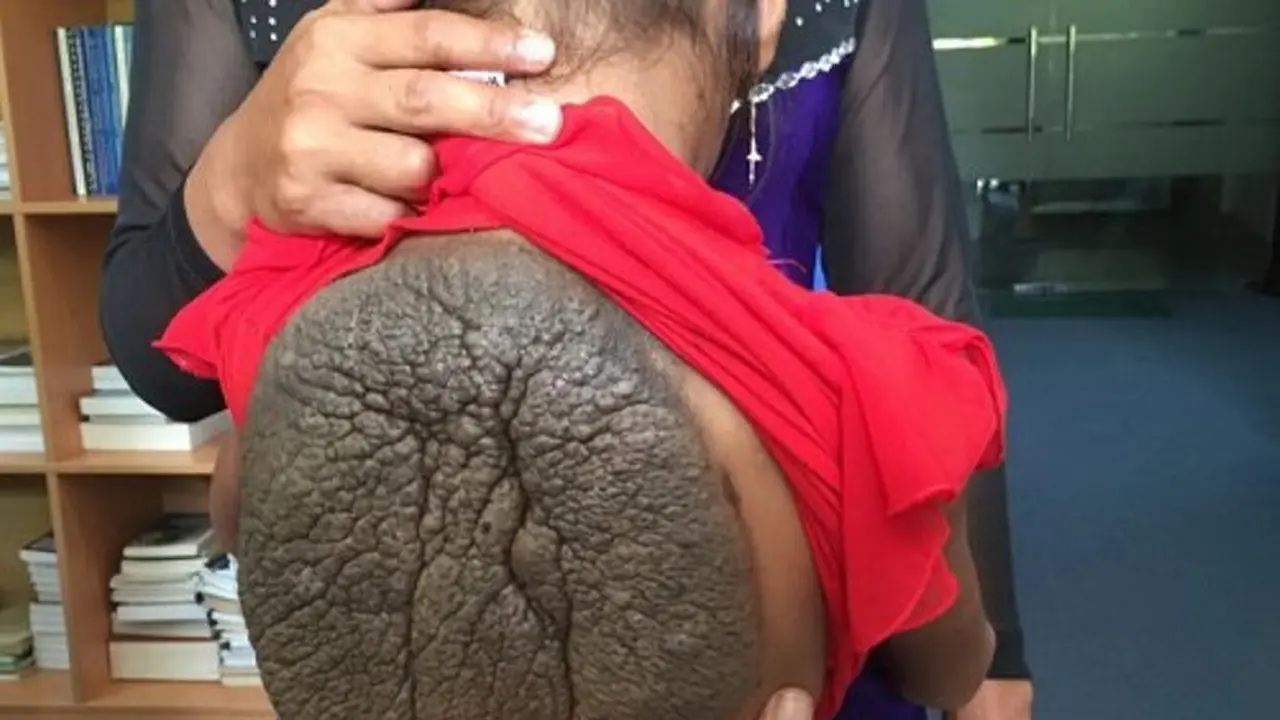 penyakit langka, 