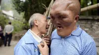 Nestapa Pria Bermuka Alien, Bagaimana Kisah Hidupnya?