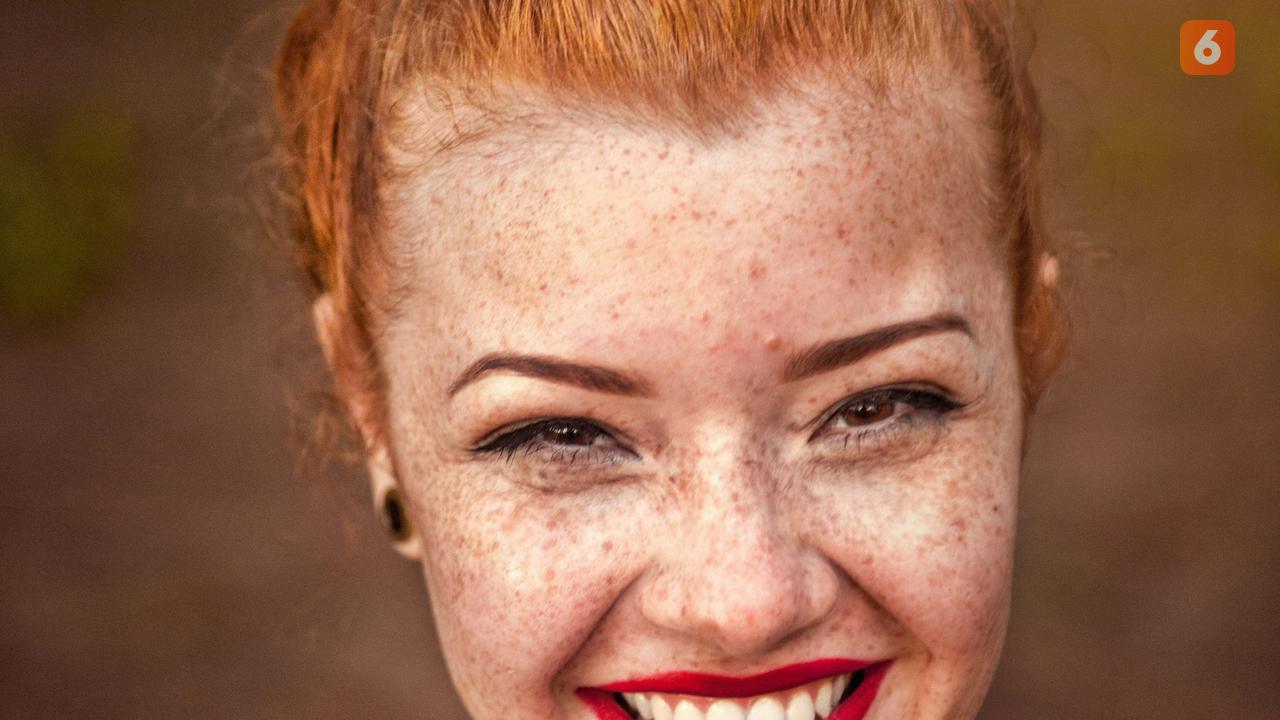 Ilustrasi hiperpigmentasi