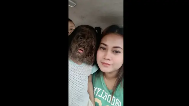 Ratu Malaysia Berencana Adopsi Anak Berusia 2 Tahun Penderita Sindrom Manusia Serigala