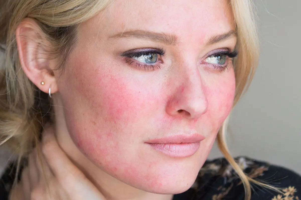 penyakit kulit rosacea