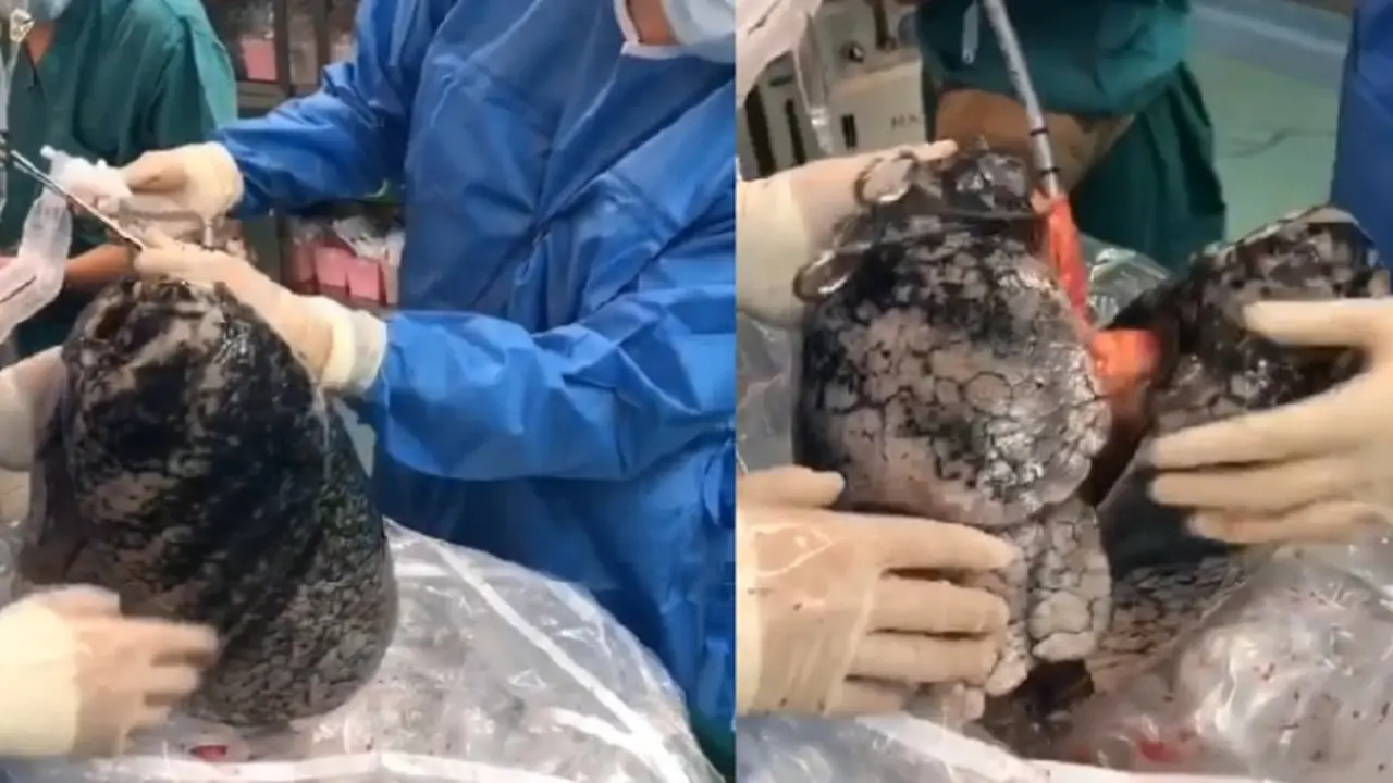 Viral Video Paru-Paru Hitam Perokok, Ditolak Saat Didonorkan