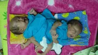 Pemeriksaan bayi kembar siam asal Subang itu dilakukan untuk mengetahui perkembangan kondisi kesehatan dan berat badan ideal memutuskan tindakan operasi pemisahan. (Sumber foto : Dadang Sjarief Hidajat)