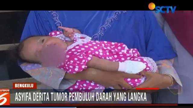 Derita Bayi Asyifa Kena Tumor Pembuluh Darah di Wajah