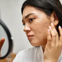 Ilustrasi ciri-ciri jerawat breakout. (c) AllaSerebrina/Depositphotos.com