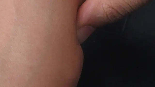 Pengobatan Lipoma