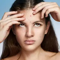 Selain debu dan kotoran yang menjadi penyebab utama jerawat, delapan hal ini menjadi indikasi munculnya jerawat di area dahi.