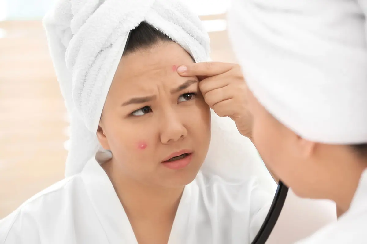 Perawatan Wajah Akurat untuk Atasi Bekas Jerawat, Acne Fighter Wajib Merapat!