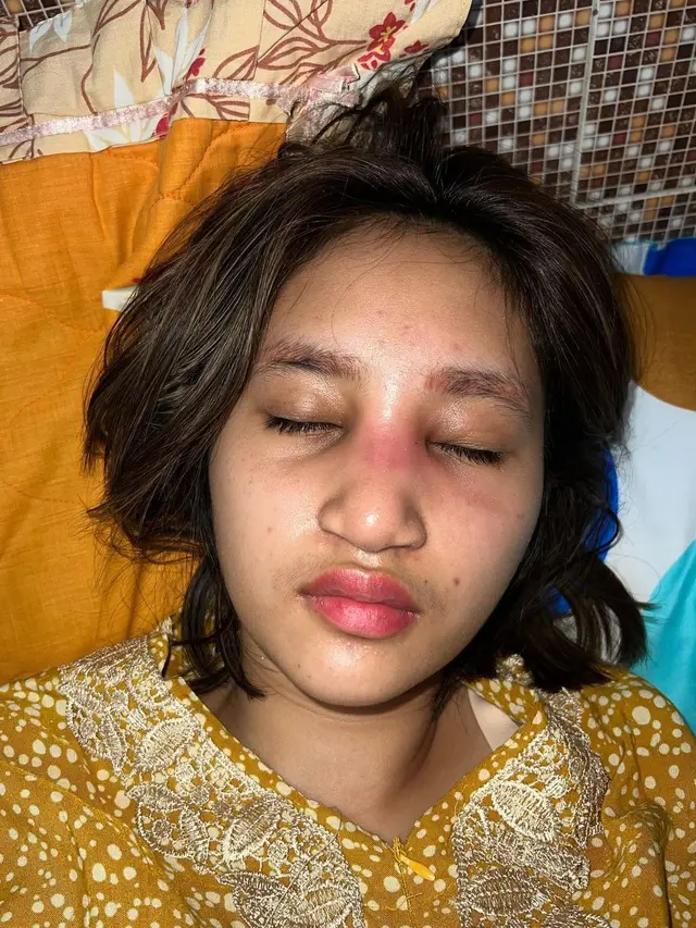 6 Potret Kronologi Dhyaz Anak Farida Nurhan Alami Infeksi Hidung Pasca Implan
