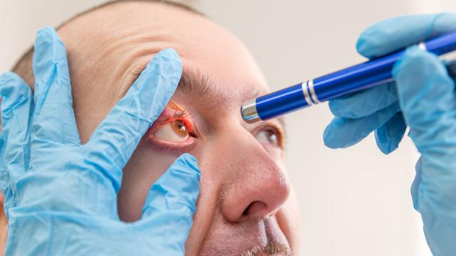 Cara Mengobati Mata Bintitan