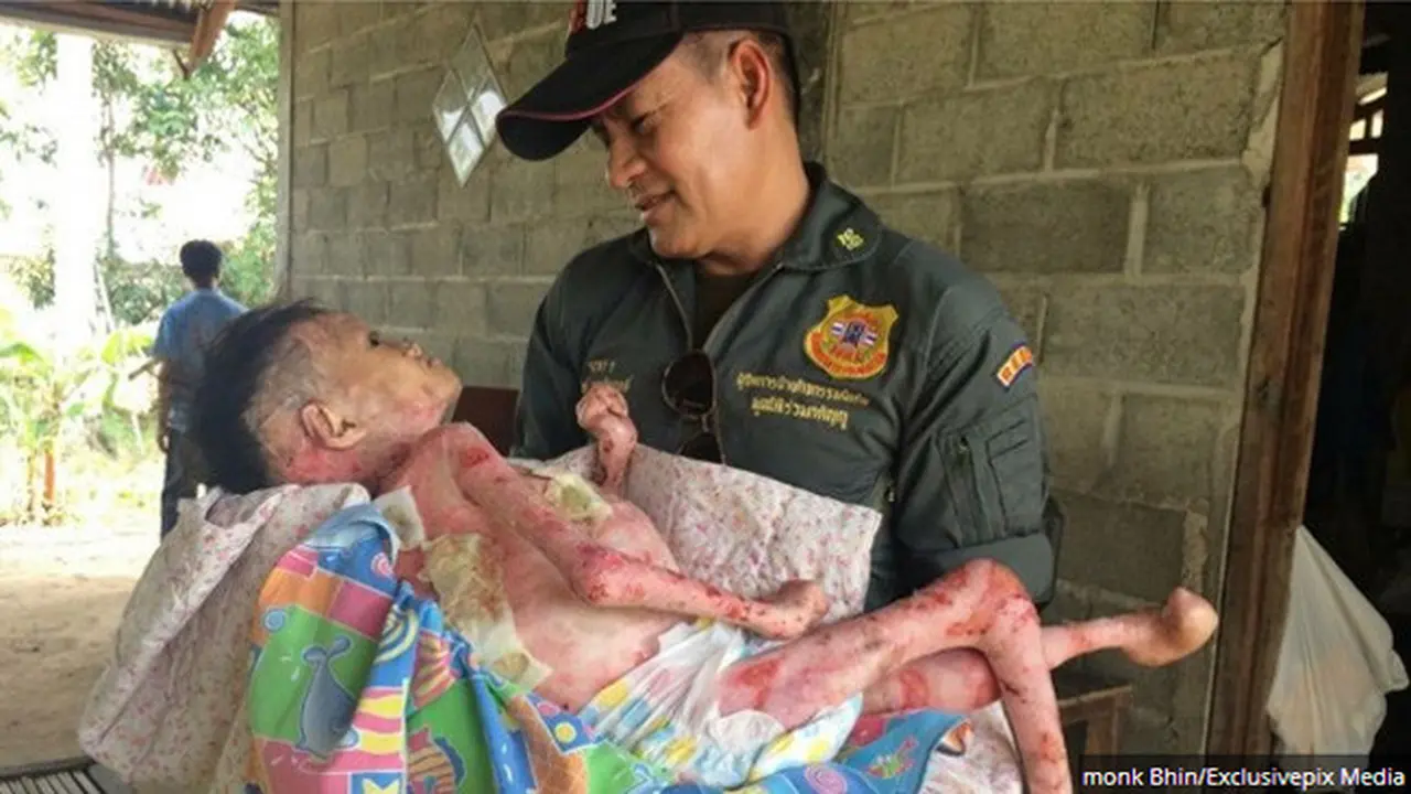 Tragis, Penderitaan Gadis 16 Tahun yang Dikerubuti Lalat