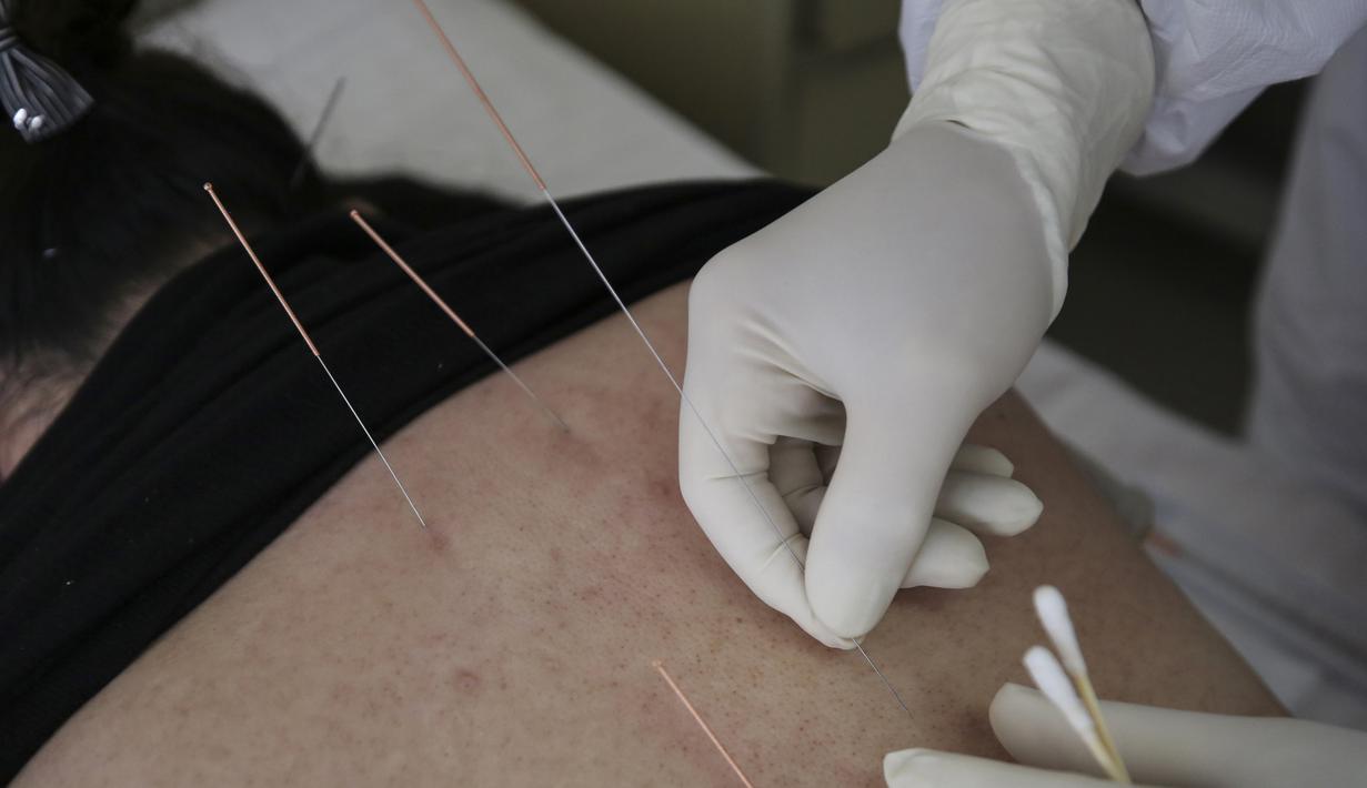 Foto Bekam Dan Akupuntur Jadi Solusi Alternatif Pengobatan Corona Covid 19 Health Liputan6 Com